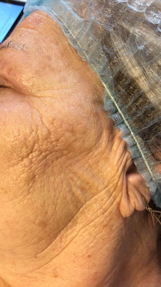LIFTING S DERMAPAREM